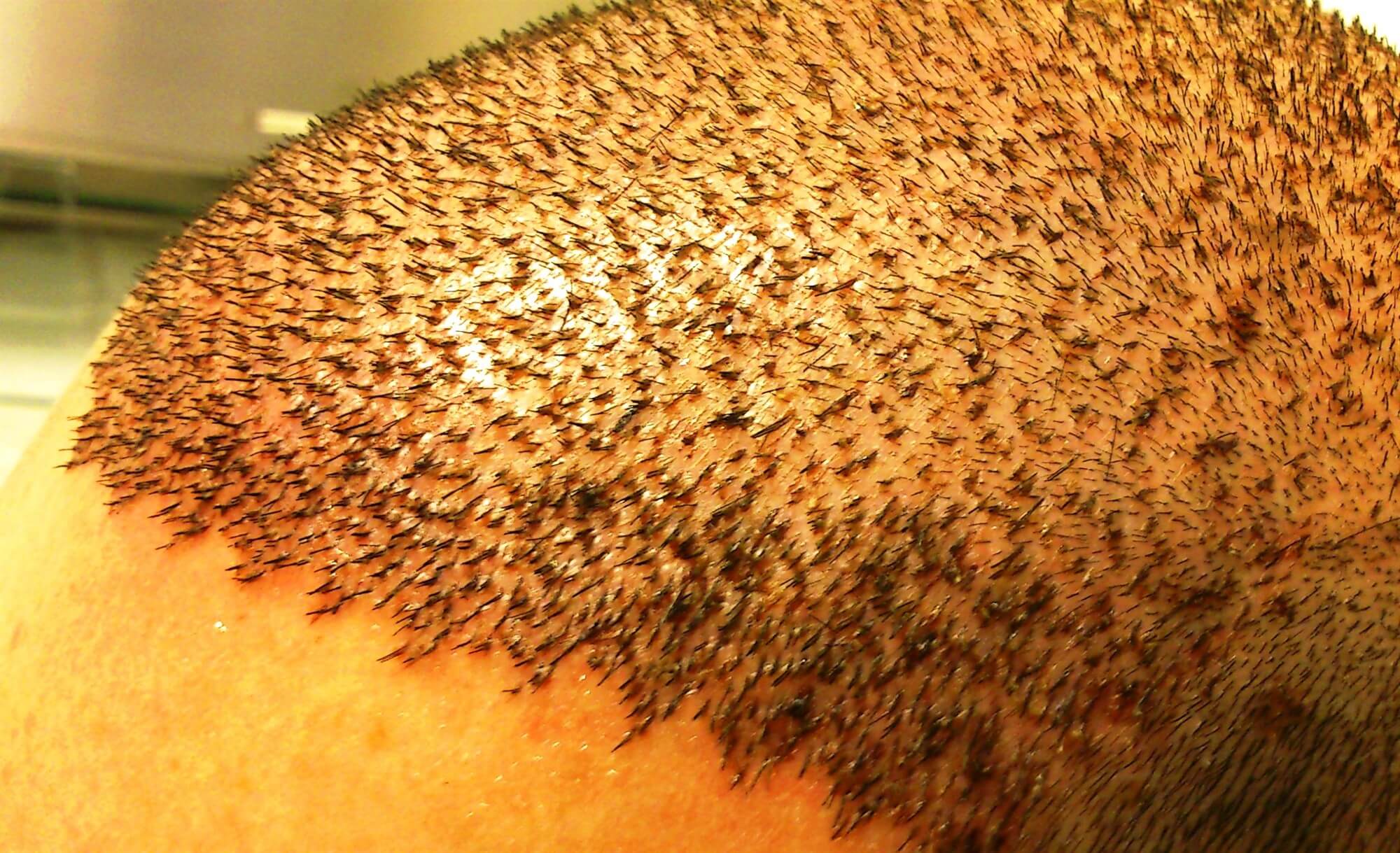 Hair Density