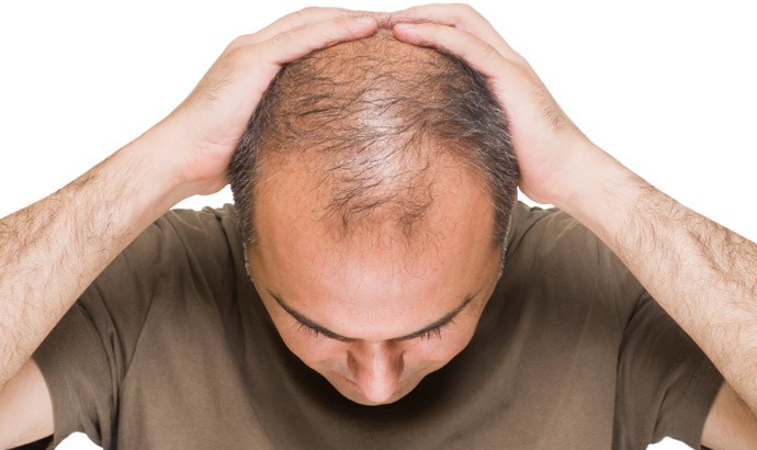 What is Hair Transplantation