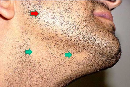 Beard Mustache and Sideburns